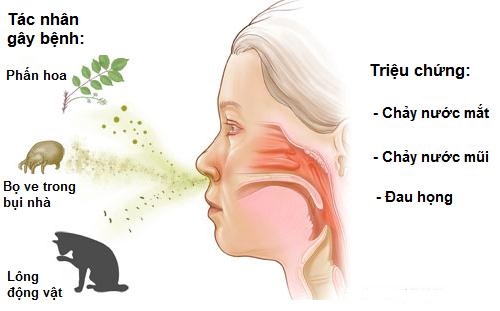 Các triệu chứng bệnh viêm xoang mũi dị ứng 