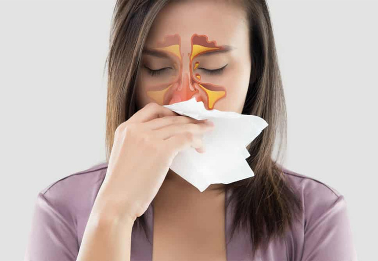 Viêm xoang mũi là bệnh lý phổ biến, có thể gặp ở mọi đối tượng